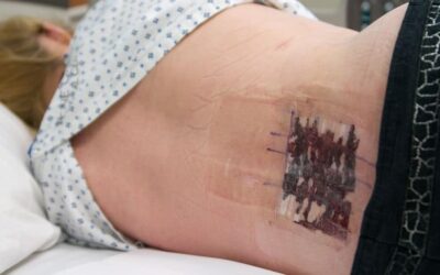 3 things Surgeons won’t tell you about Back surgery.