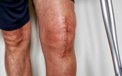 Knee Surgery: Another reason why it isn’t a good choice