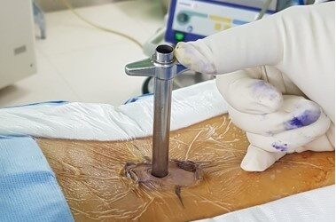 Back Fusion: How common are complications from surgery?