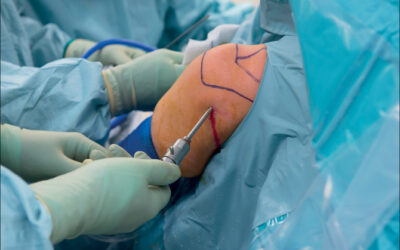 Shoulder decompression Surgery: Is it better than doing nothing?