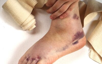 Ankle Sprain: Will taking anti-inflammatories help healing?