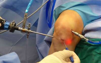Knee Pain and arthroscopy: should you have it?