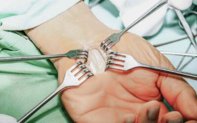 Carpal tunnel surgery: Will you go back to work after?