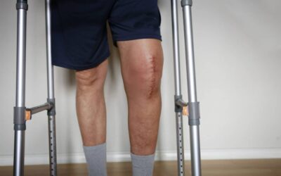 ACL surgery: will you go back to normal?
