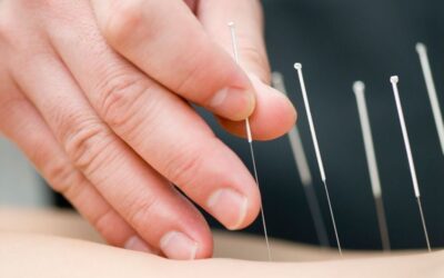 Acupuncture for fibromyalgia: only a short-term solution