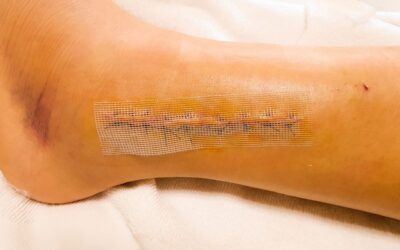 Complications after ankle replacement