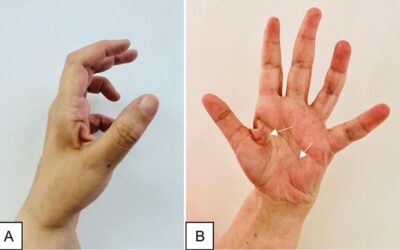 Ulnar Nerve Injury Following Open Carpal Tunnel Release: A Case Report