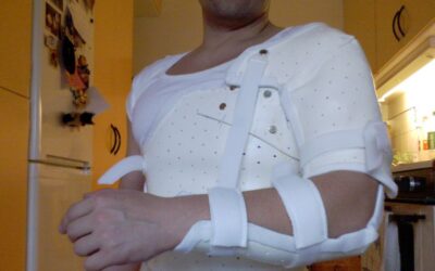 Shoulder replacement: will you need another operation?
